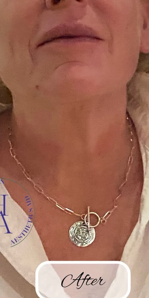 Botox — after