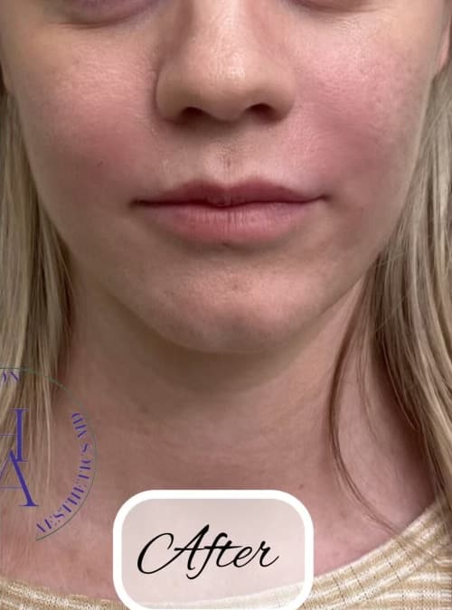 Cheek Fillers — after