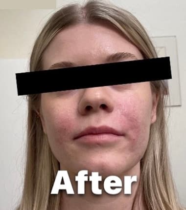 Cheek Fillers — after