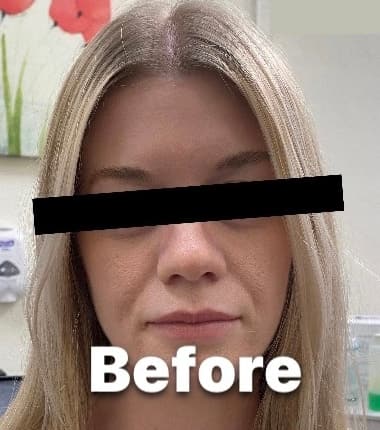 Cheek Fillers — before