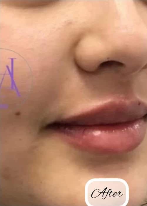 Dermal Fillers — after