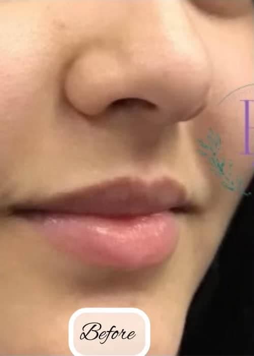 Dermal Fillers — before