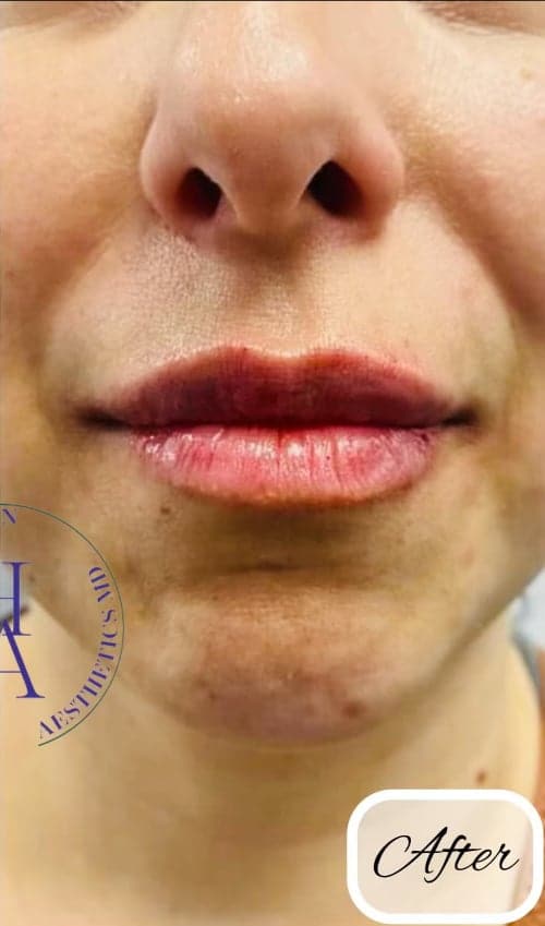 Dermal Fillers — after