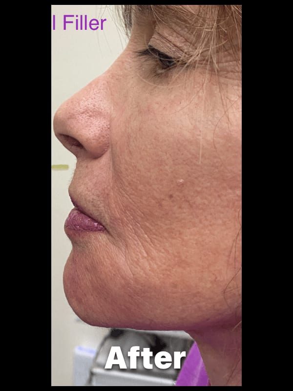 Dermal Fillers — after