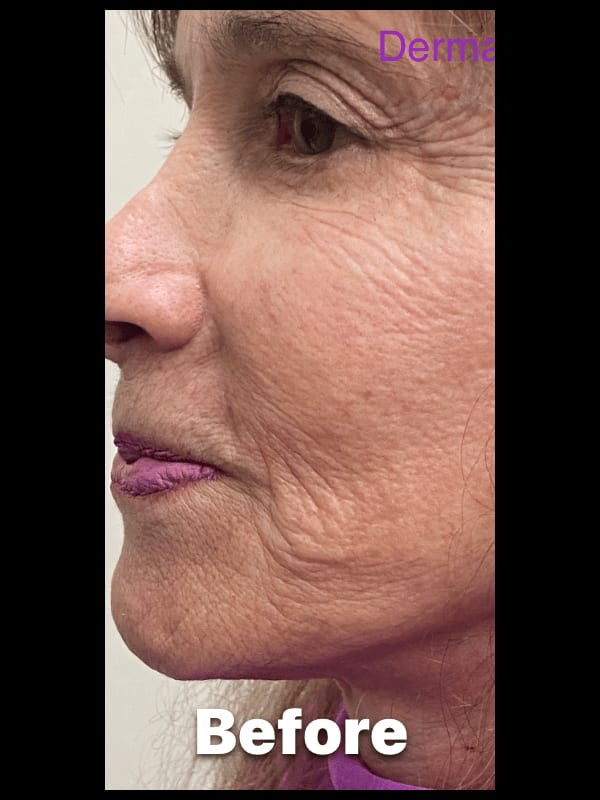 Dermal Fillers — before
