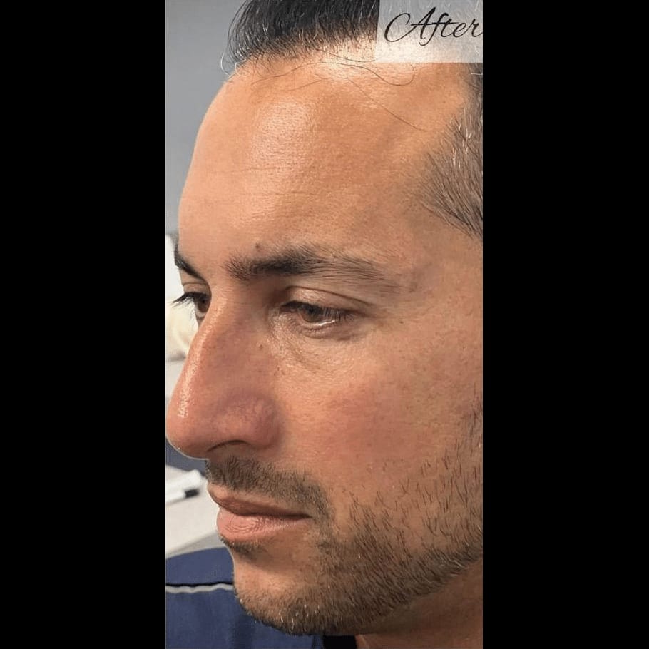Geneo Balance Facial — after