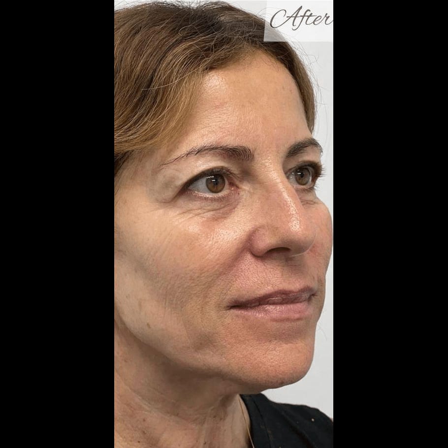 Glo2 Facial — after