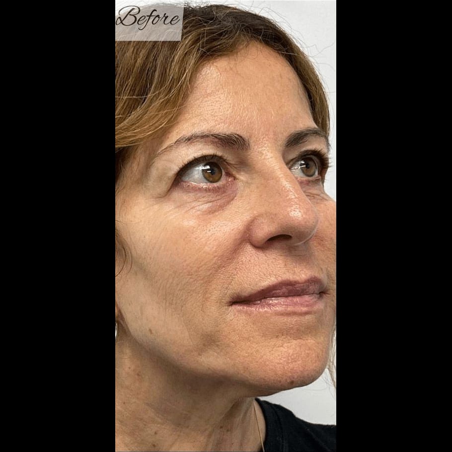 Glo2 Facial — before