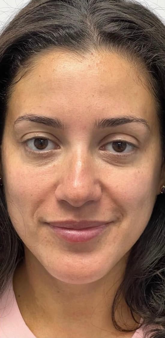 Glo2 Facial — after
