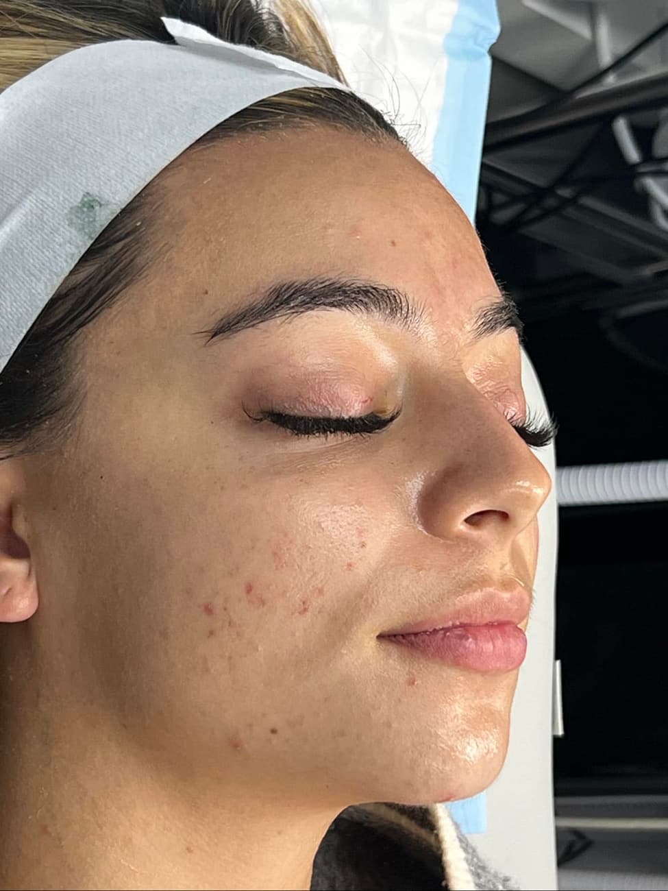 Glo2 Luxe Facial — after