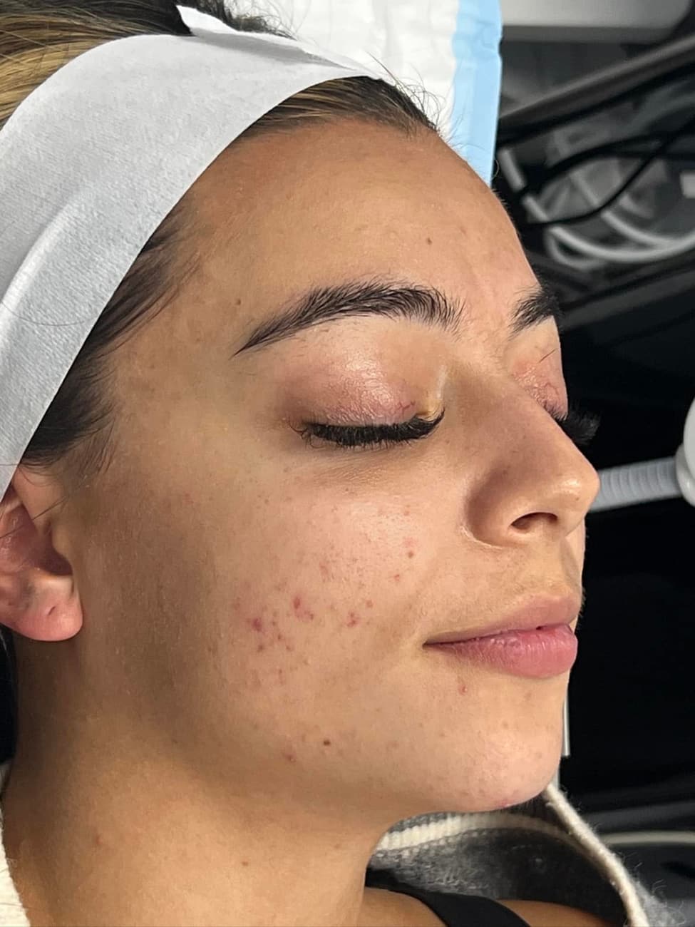 Glo2 Luxe Facial — before