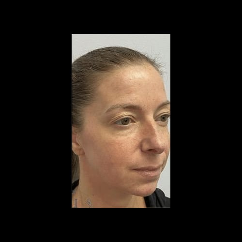 Intense Pulsed Light (IPL) — after