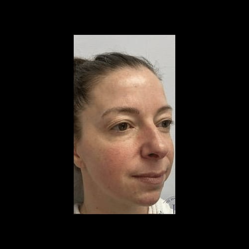 Intense Pulsed Light (IPL) — before
