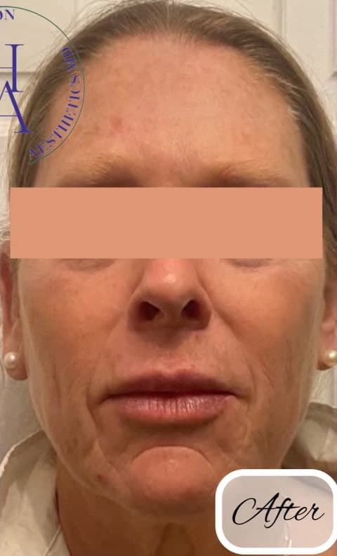 Intense Pulsed Light (IPL) — after