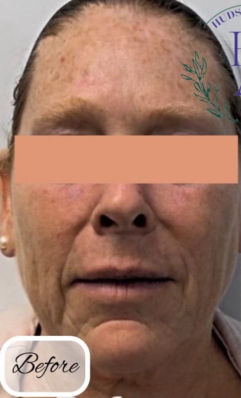 Intense Pulsed Light (IPL) — before