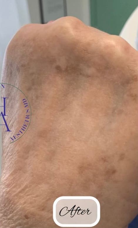 Intense Pulsed Light (IPL) — after