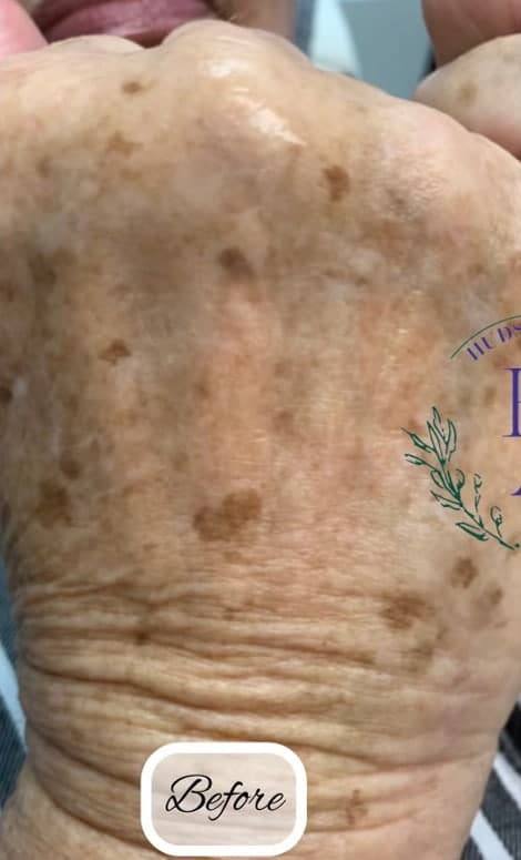 Intense Pulsed Light (IPL) — before