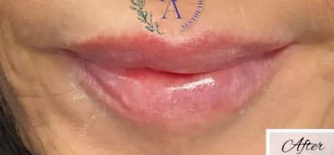 Lip Fillers — after