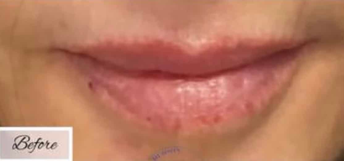 Lip Fillers — before