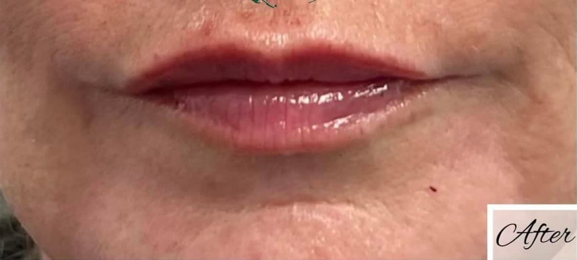 Lip Fillers — after