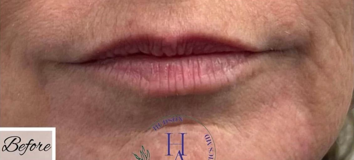 Lip Fillers — before