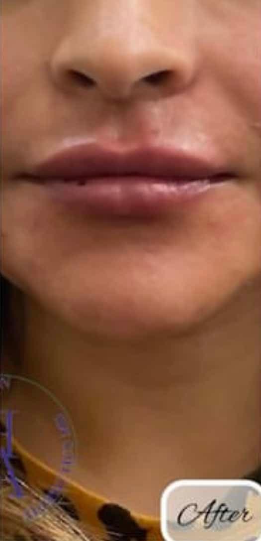 Lip Fillers — after