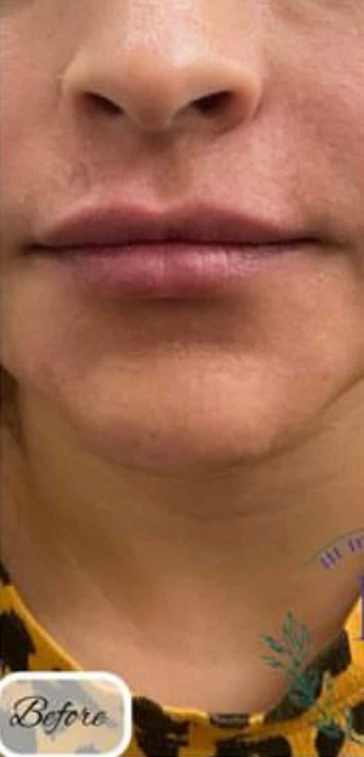 Lip Fillers — before
