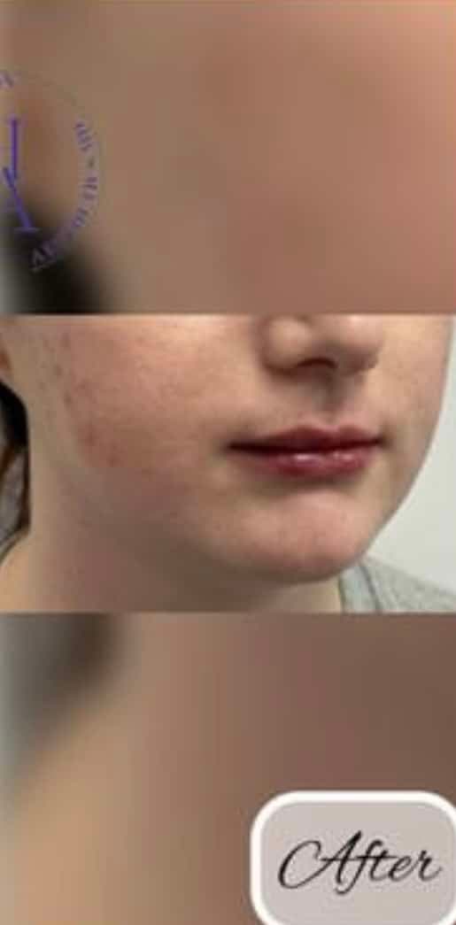 Lip Fillers — after