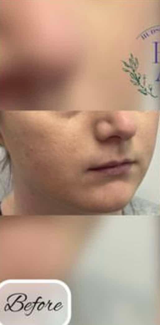 Lip Fillers — before