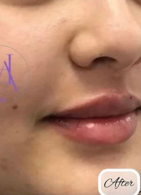 Lip Fillers — after