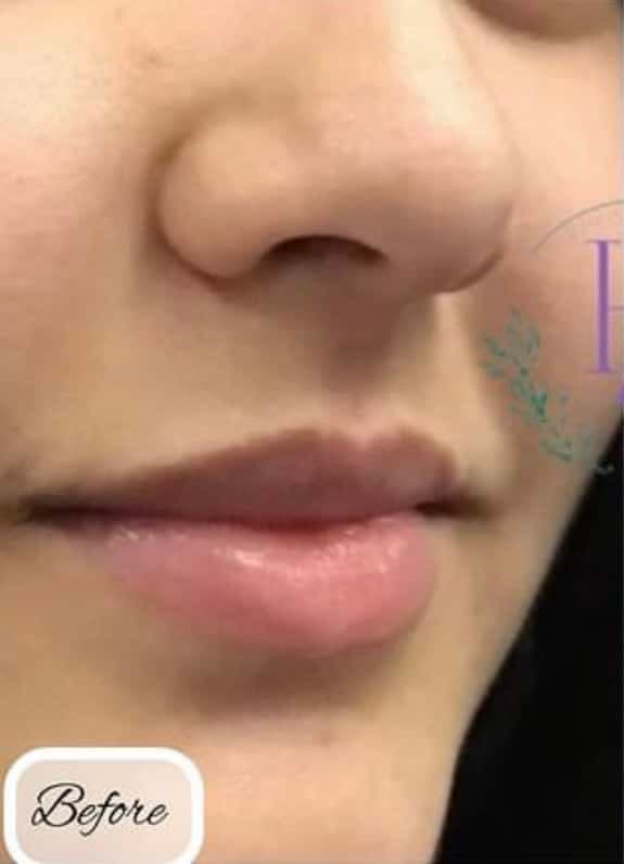 Lip Fillers — before
