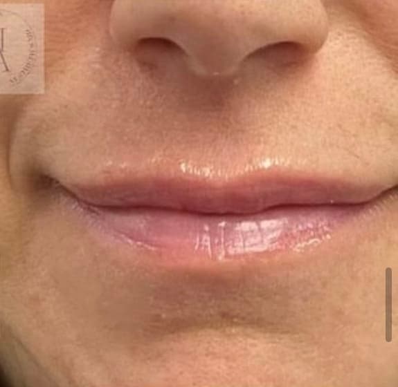 Lip Flip — after