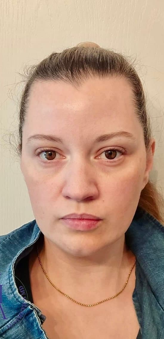 Masseter Botox — after