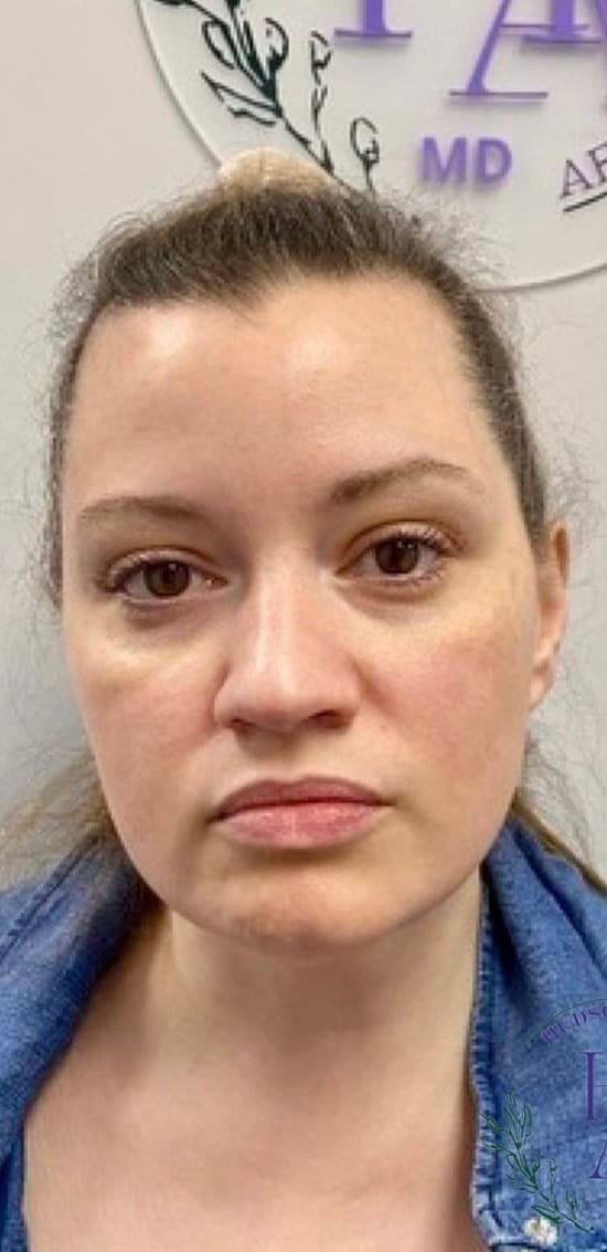 Masseter Botox — before