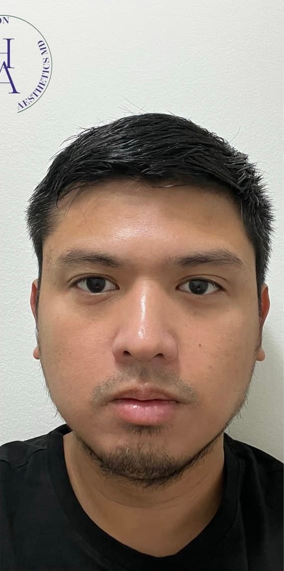 Masseter Botox — after