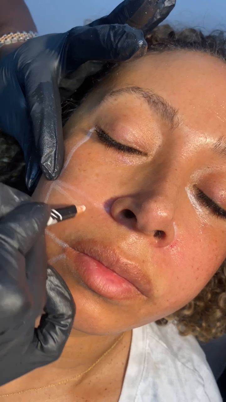 Dr. Kerline Marcelin injecting a patient’s cheek along mapped guide lines at Hudson Aesthetics MD