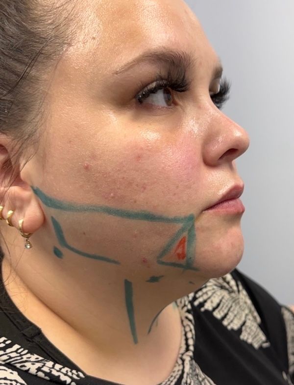 A patient’s jawline and neck marked out for FaceTite at Hudson Aesthetics MD