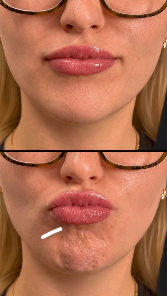A patient’s chin being marked by a gloved hand before a Botox treatment at Hudson Aesthetics MD