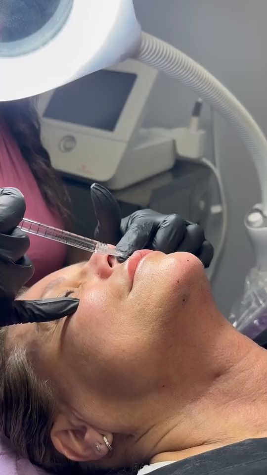 Dermal filler being injected into a patient’s lip at Hudson Aesthetics MD