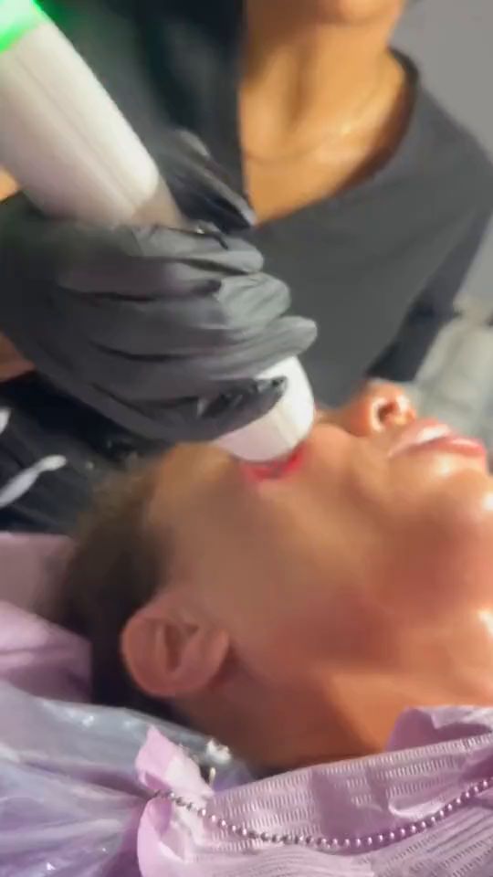 The Moxi laser handpiece passing across a patient’s cheek, its red aiming light on the skin