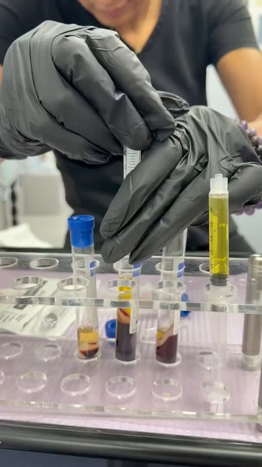 A rack of centrifuged blood samples, the platelet-rich plasma separated and ready to draw