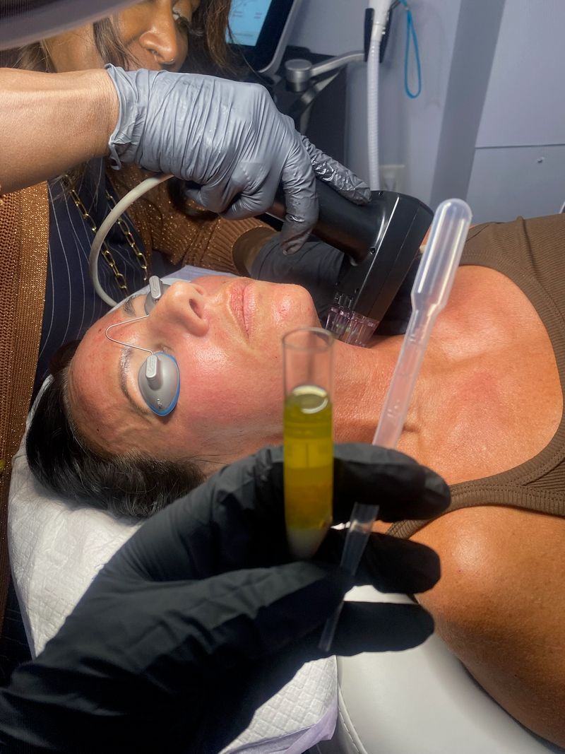 A tube of the patient’s own platelet-rich plasma, ready to apply during a microneedling treatment at Hudson Aesthetics MD