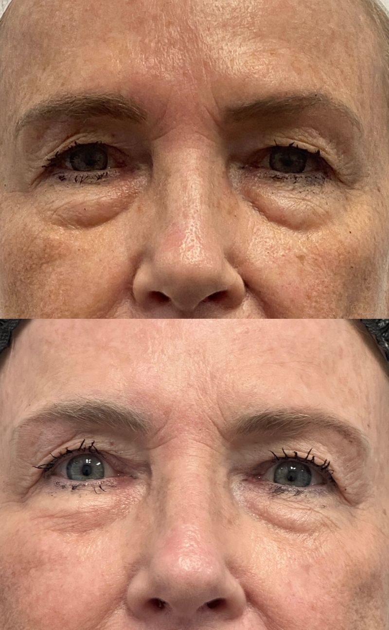 AccuTite under-eye results: puffy lower-eyelid bags before (top) and a smoother, flatter lower lid after (bottom)