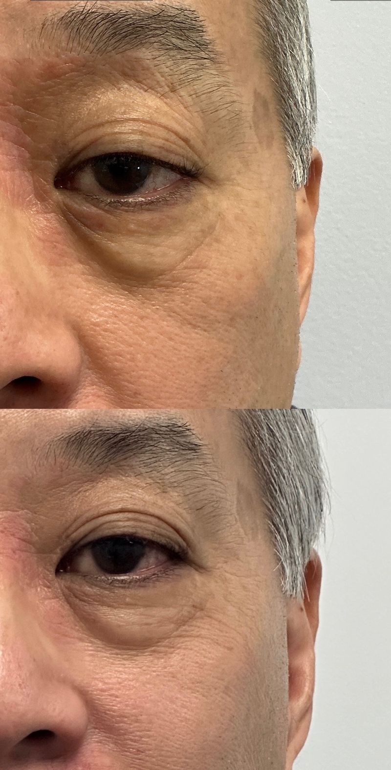 AccuTite results for a male patient: under-eye bags before (top) and visibly reduced after (bottom)