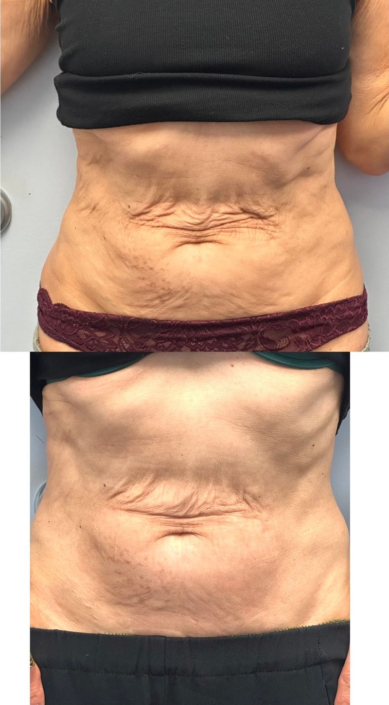 BodyTite results: a patient’s abdomen seen from the front before (top), the skin above the navel loose and crepey, and after (bottom), visibly smoother and firmer