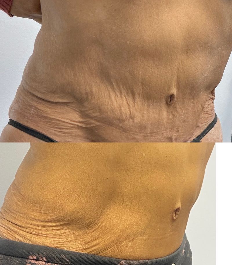 BodyTite results: a patient’s abdomen seen from the side before (top) and after (bottom), with the lax skin above the waistband tightened
