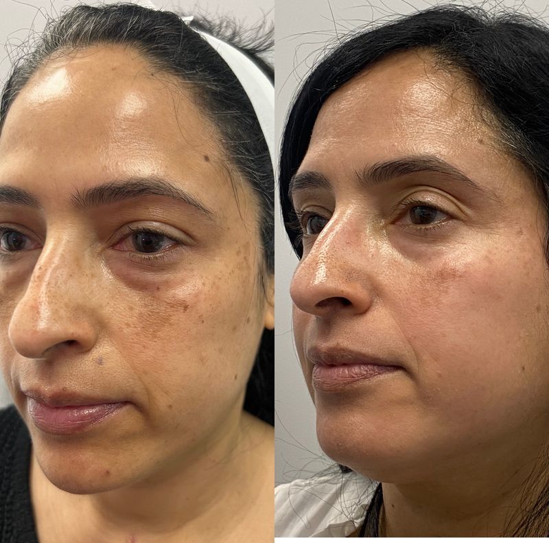 Cosmelan pigmentation treatment results: brown patches on a patient’s cheek in January 2024, visibly lighter by April 2026