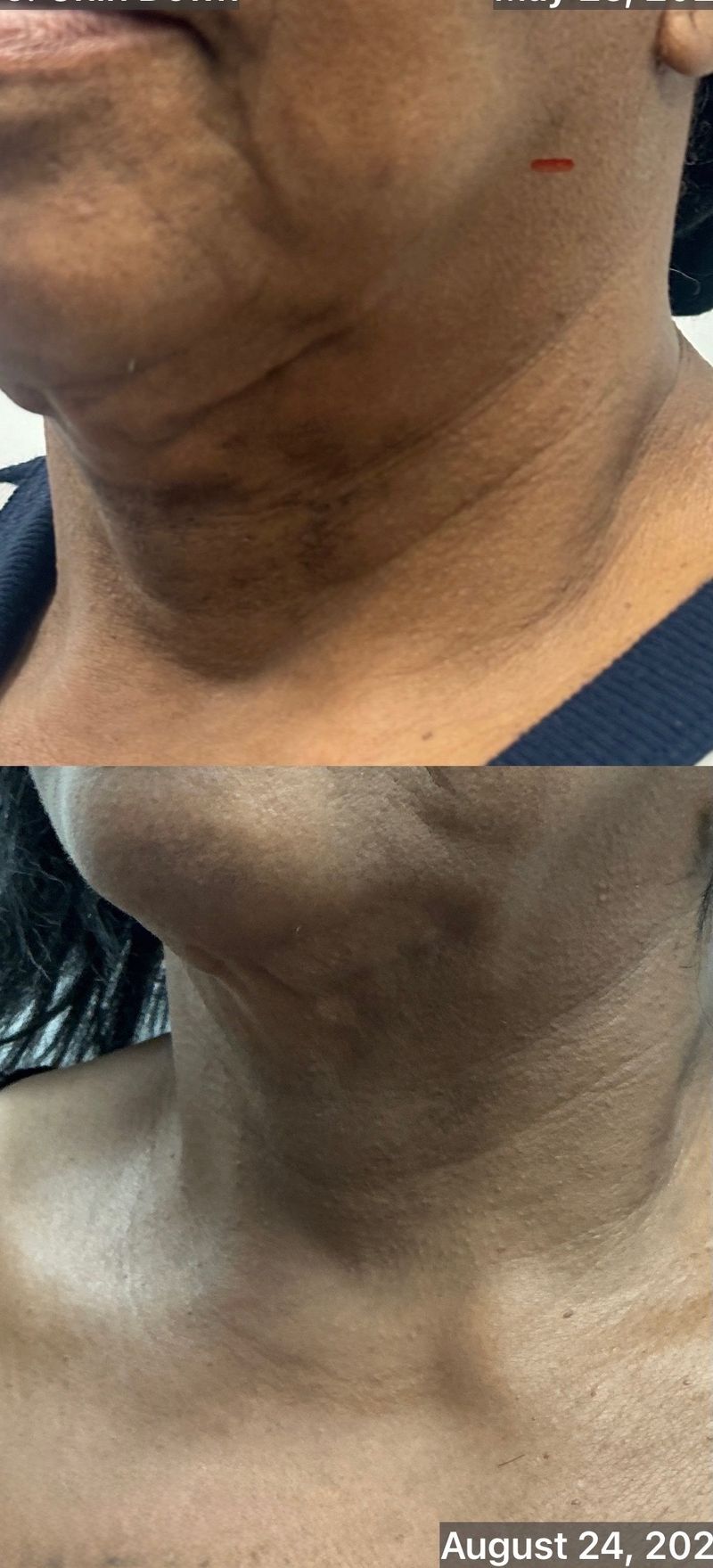 A patient’s chin and neck before and after FaceTite at Hudson Aesthetics MD