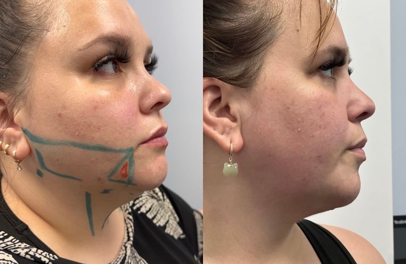 FaceTite jawline results: a patient’s profile with the treatment area marked before (left) and a more defined jawline and neck after (right)