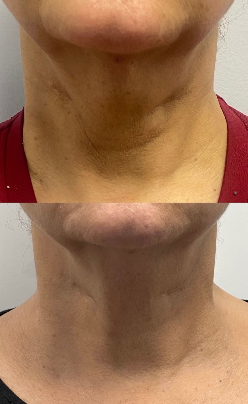 FaceTite neck results: loose skin under the chin before (top) and a firmer, smoother neck after (bottom)